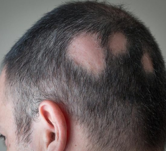 Alopecia1