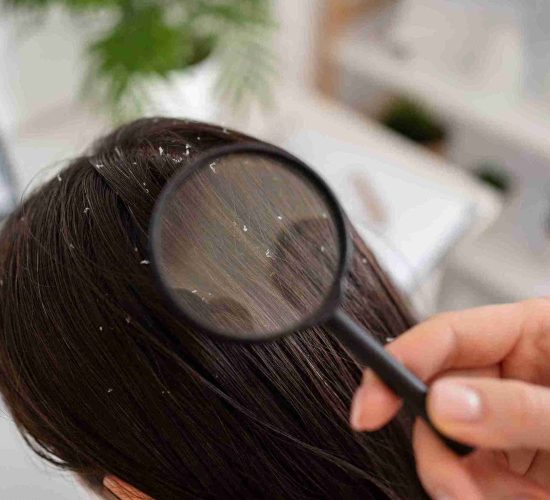 Dandruff1